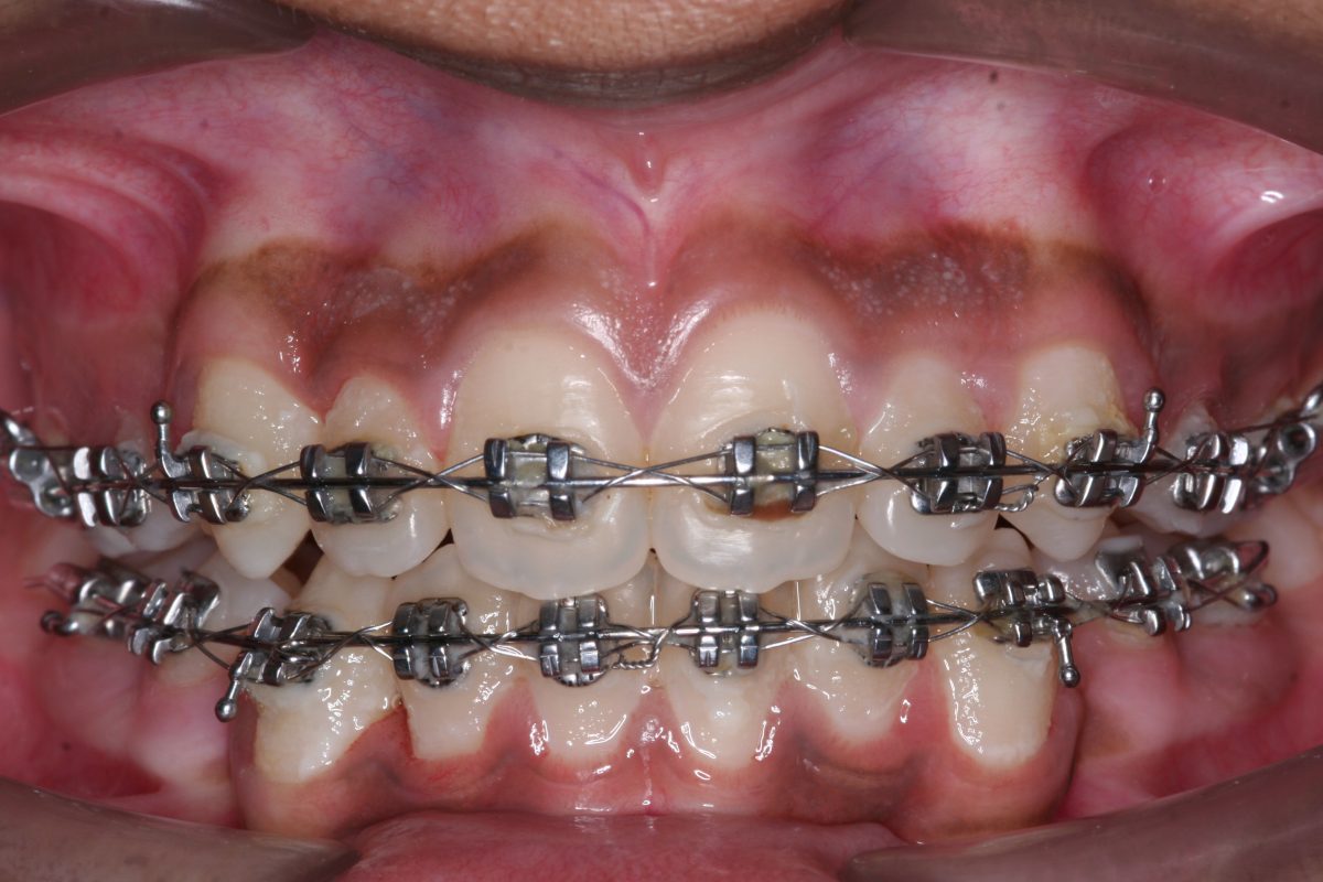 braces 2