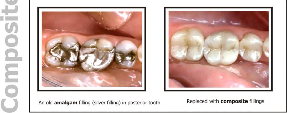 TOOTH COLORED FILLINGS